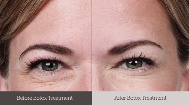 Botox for crow's feet before and after - Dark Eye Circles by Dr Gerard Ee Singapore